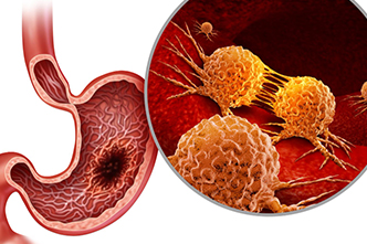 Gastrointestinal Cancer Surgery in Vijayawada